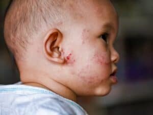 Baby Eczema Broken Skin