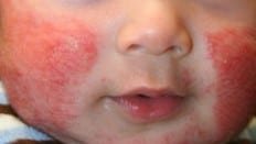 Baby Eczema Inflamed Skin