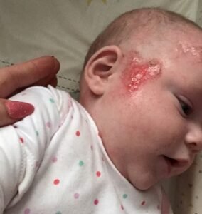 Baby Eczema Scab