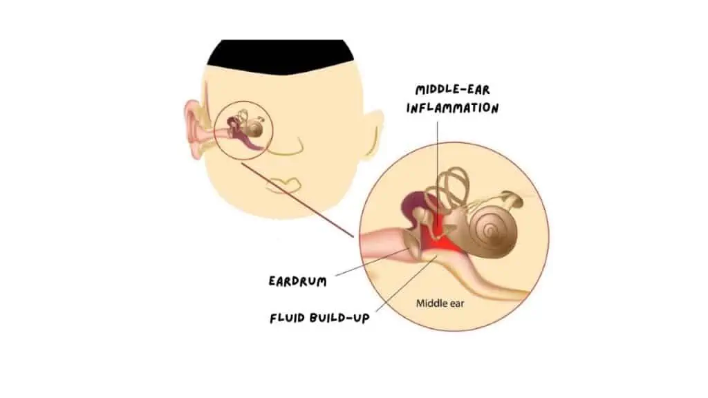 penyakit biasa kanak-kanak - jangkitan telinga