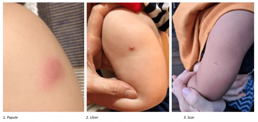 BCG 3 stages of site development 1 1024x486 1 BCG 3 stages of site development 1Getting to Know About Different Types of Baby Vaccinations -Firststep Child Specialist Clinic