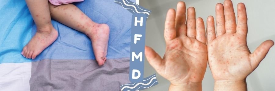Menjelaskan Penyakit Tangan, Kaki dan Mulut (HFMD)