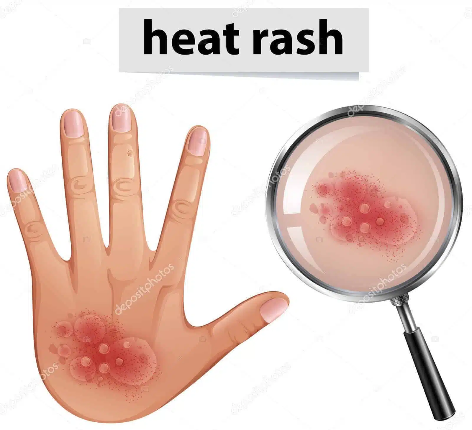Understanding Heat Rash in Children: Causes, Symptoms, and Treatment 1 Heat Rash
