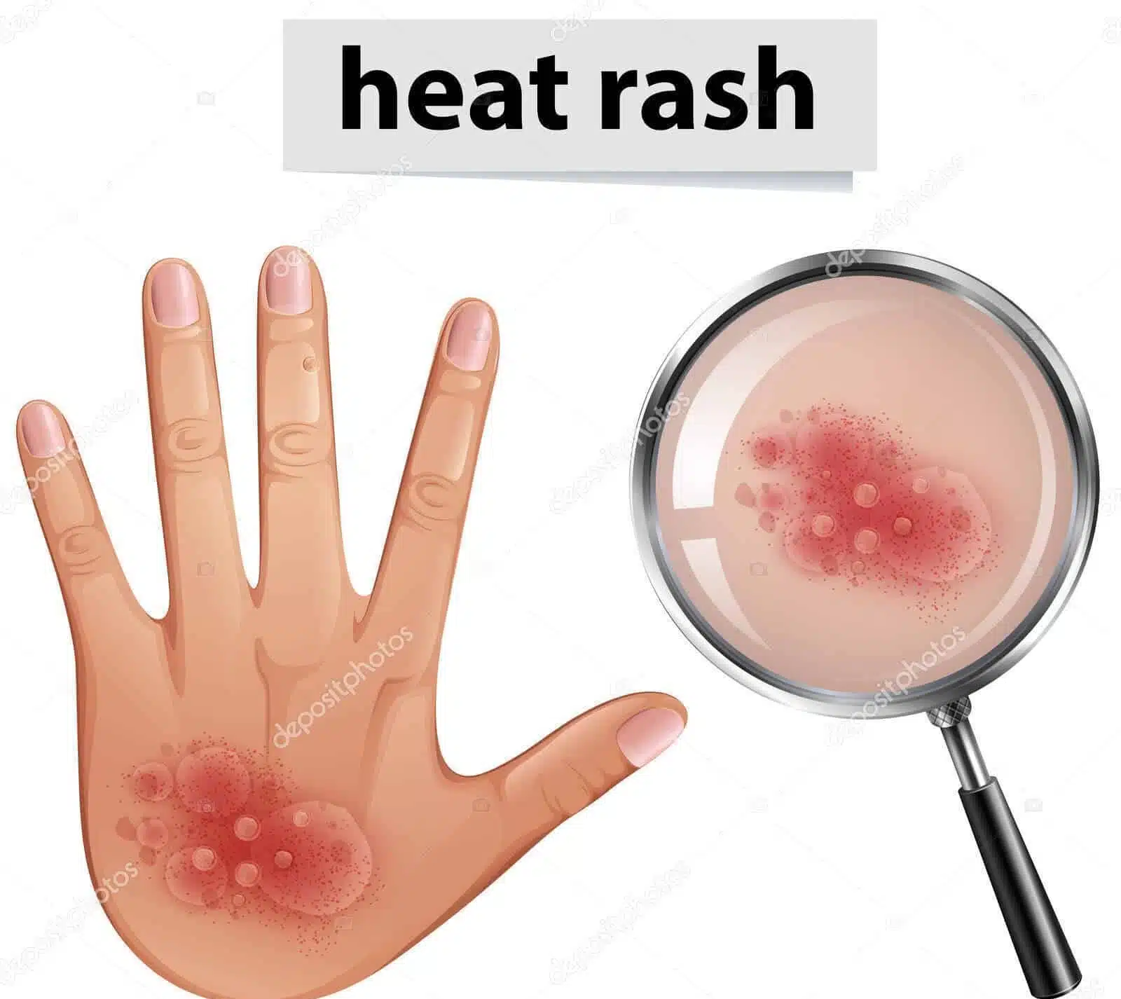 Memahami Ruam Panas pada Kanak-Kanak: Punca, Gejala, dan Rawatan 1 Heat Rash