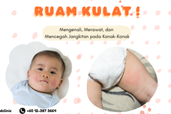 Ruam Kulat Pada Bayi