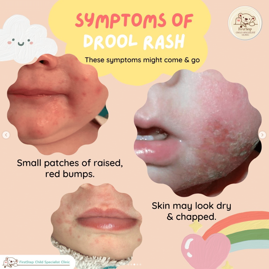 drool rash