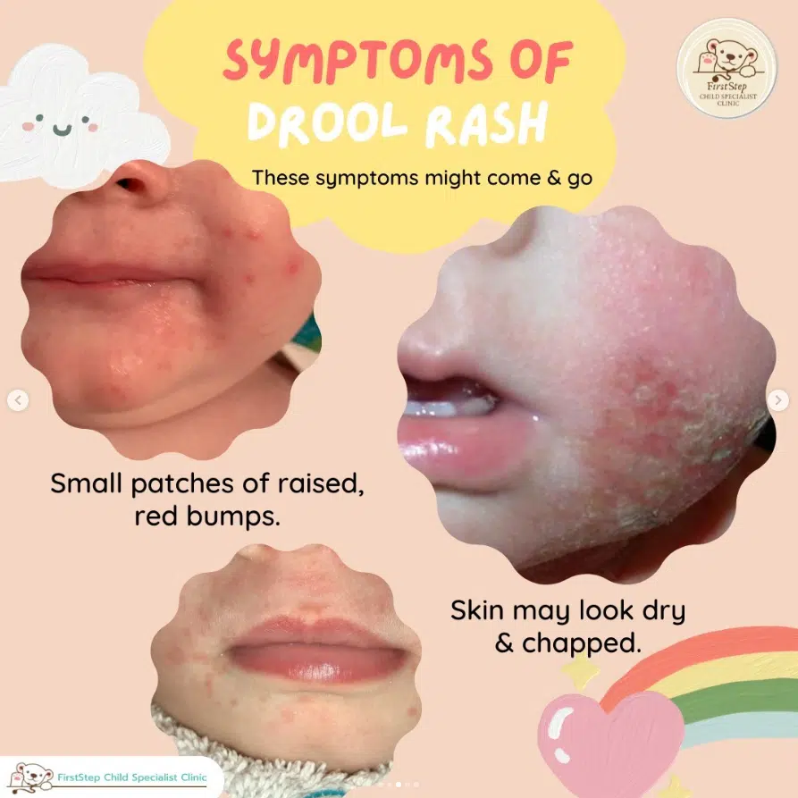 drool rash