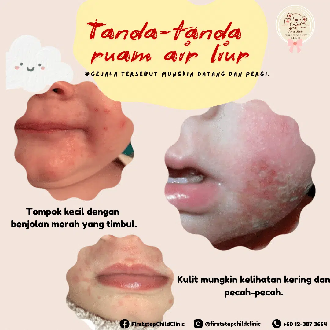 Air Liur Bayi:Perlukah anda risau? 2 ruam air liur