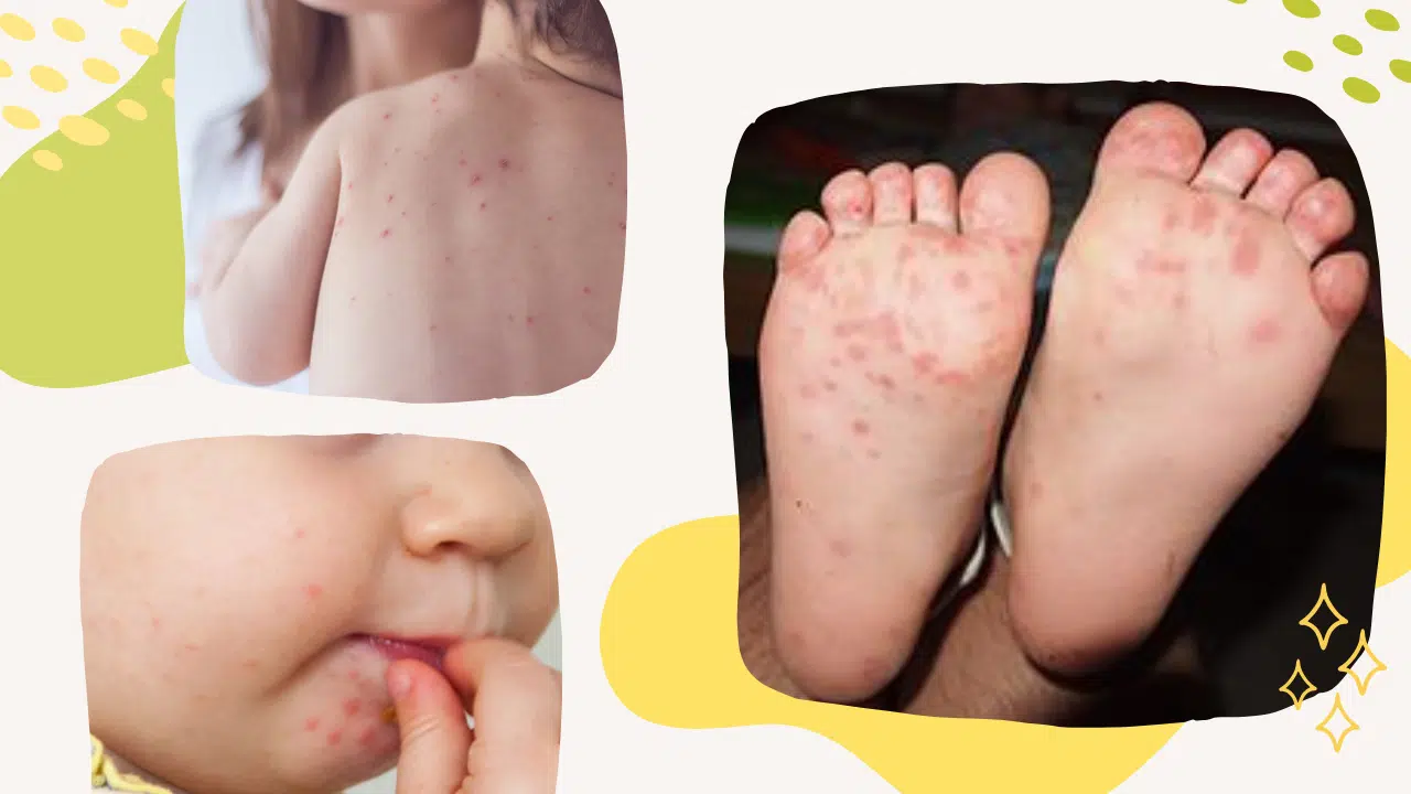 HFMD: Jaga Si Kecil dari Jangkitan! 1 HFMD