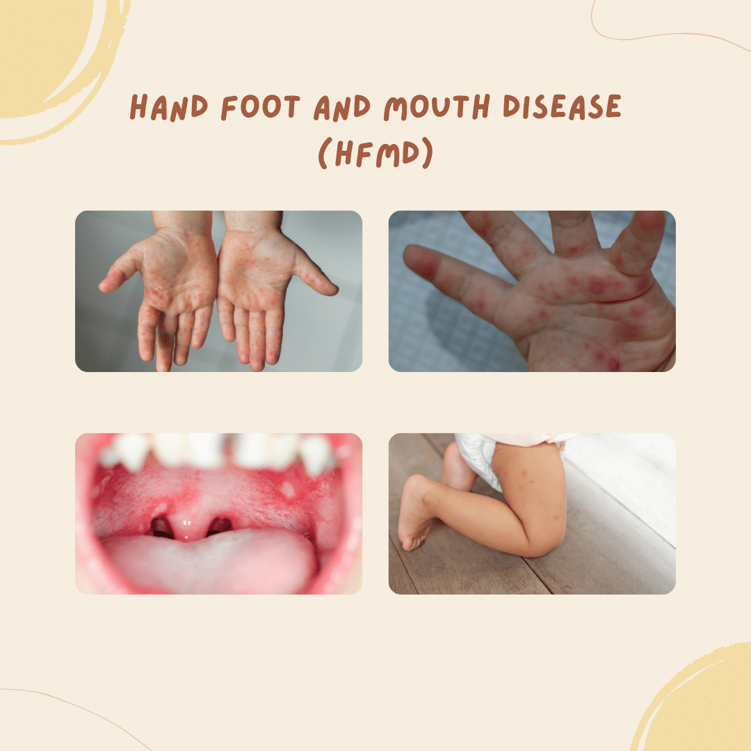 Hand foot and mouth disease (HFMD)